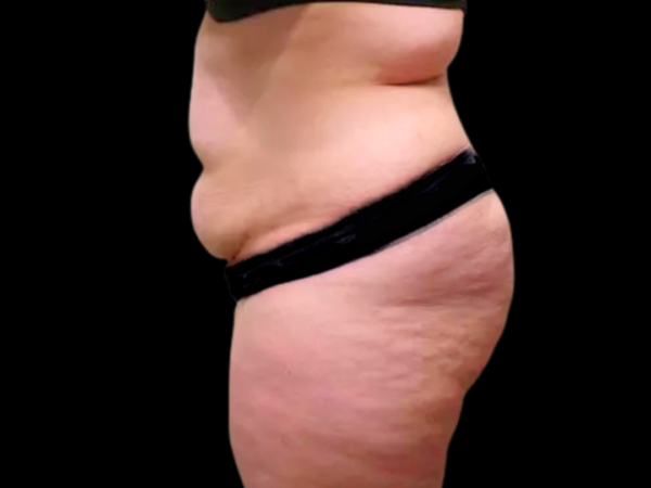 Tummy Tuck Patient 03 Before 2
