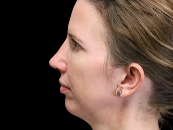 Rhinoplasty Patient 35 After 2