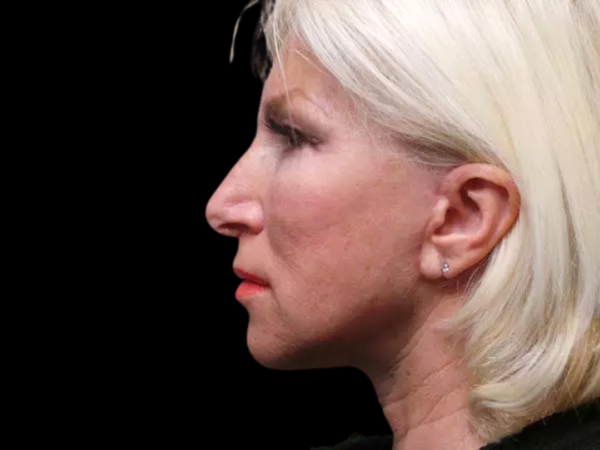 FaceLift Patient 04 After 2