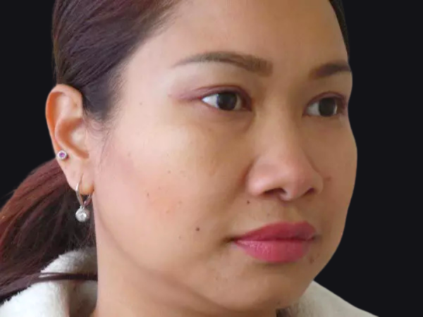 Eyelid Surgery Patient 04 After 2