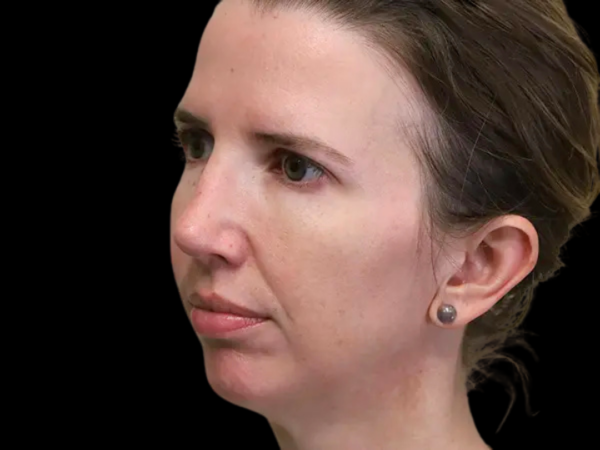 Rhinoplasty Patient 35 After 1