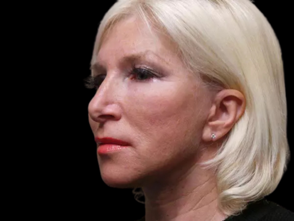 FaceLift Patient 04 After 1