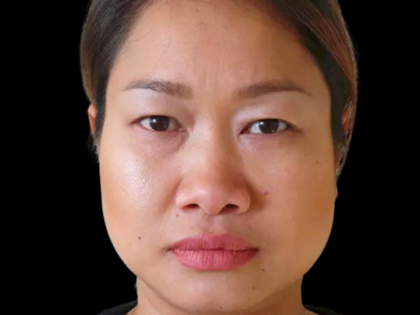 Eyelid Surgery Patient 04 Before 1