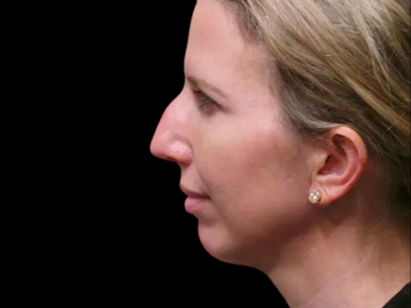 Rhinoplasty Patient 35 Before 2
