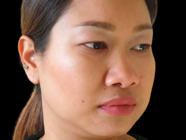 Eyelid Surgery Patient 04 Before 2
