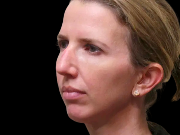 Rhinoplasty Patient 35 Before 1