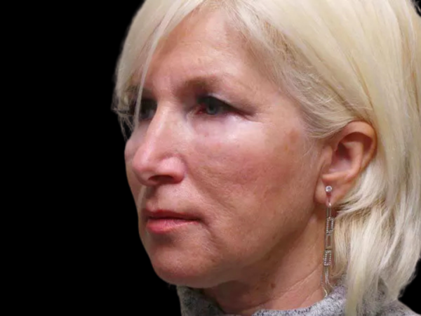 FaceLift Patient 04 Before 1