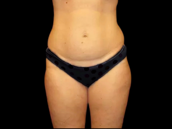 Liposuction Patient 08 Before 1