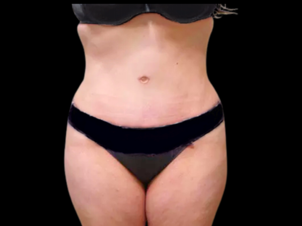 Tummy Tuck Patient 04 After 1