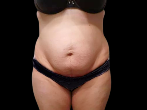Tummy Tuck Patient 04 Before 1