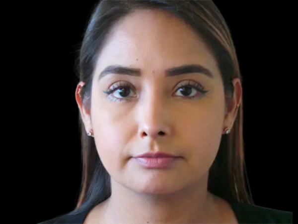 Rhinoplasty Patient 01 After 1