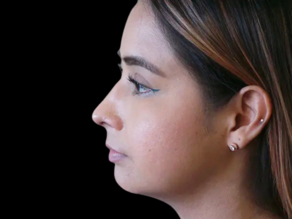 Rhinoplasty Patient 01 After 2