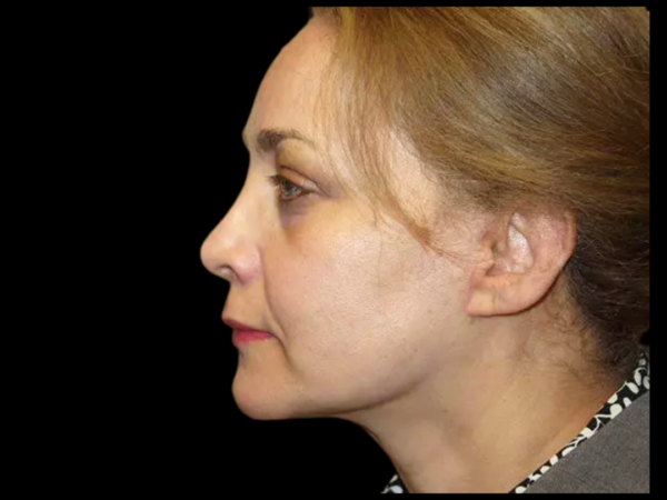 Facelift Patient 10 After 1
