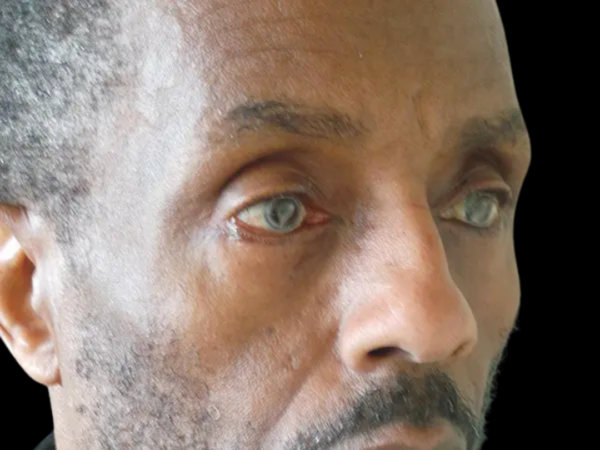 Eyelid Surgery Patient 23 After 2