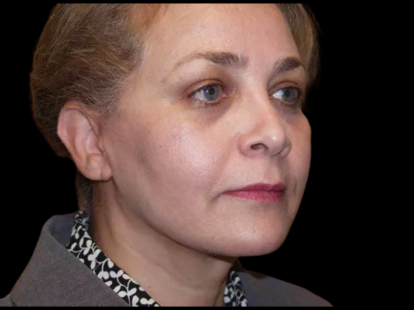 Facelift Patient 10 After 2