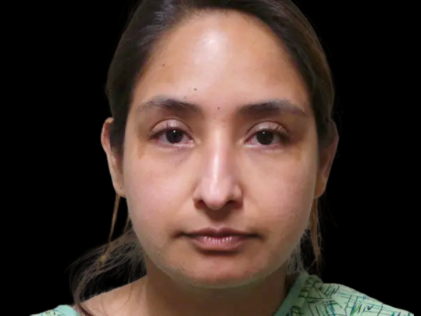 Rhinoplasty Patient 01 Before 1