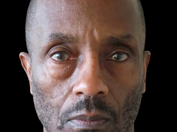 Eyelid Surgery Patient 23 Before 1