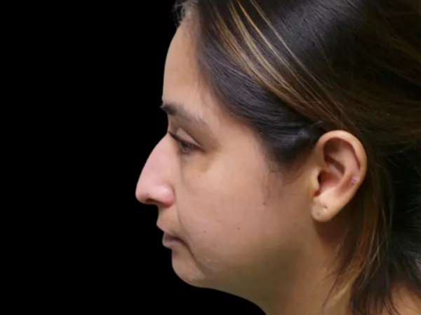 Rhinoplasty Patient 01 Before 2