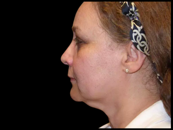 Facelift Patient 10 Before 1