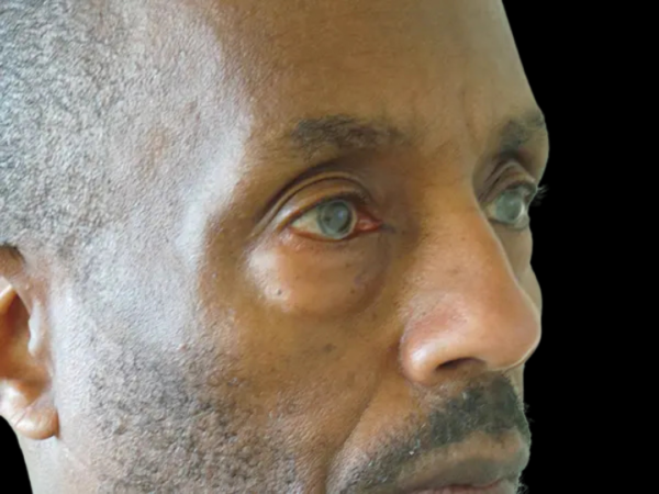 Eyelid Surgery Patient 23 Before 2