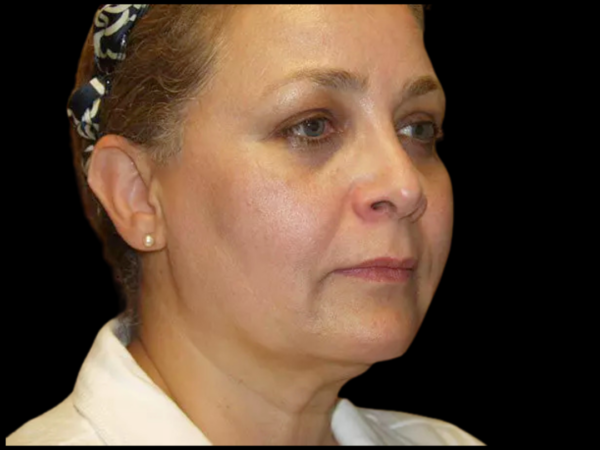 Facelift Patient 10 Before 2