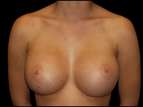 Breast Augmentation Patient 19 After 1