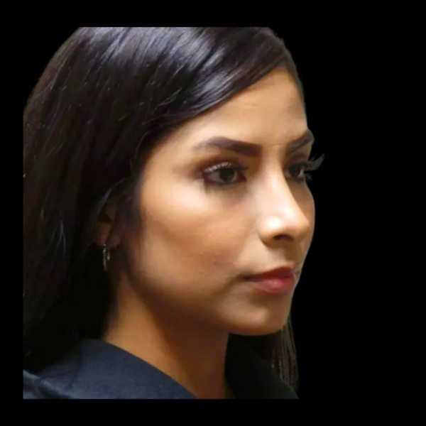 Rhinoplasty #360 After 1