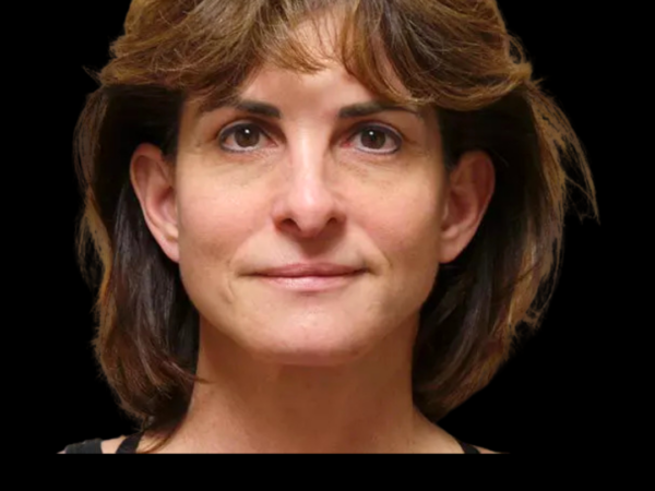 Facelift Patient 09 After 1