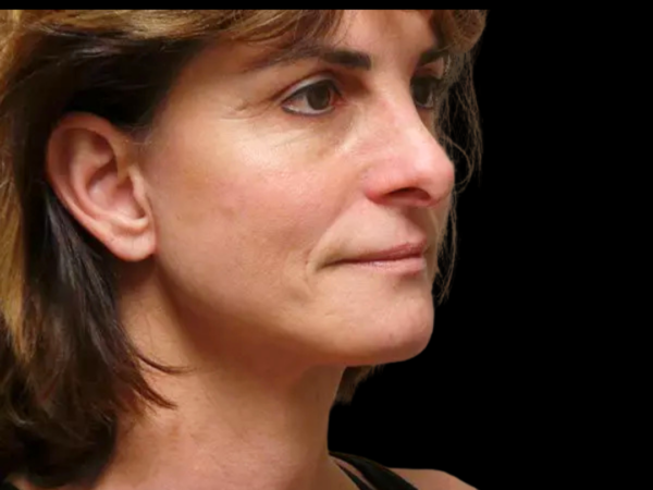 Facelift Patient 09 After 2