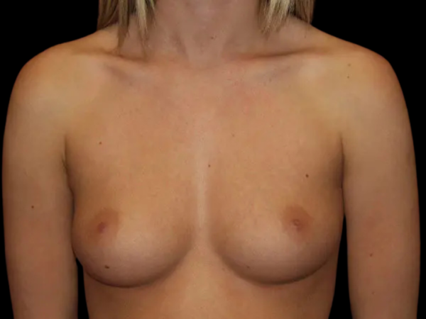 Breast Augmentation Patient 19 Before 1