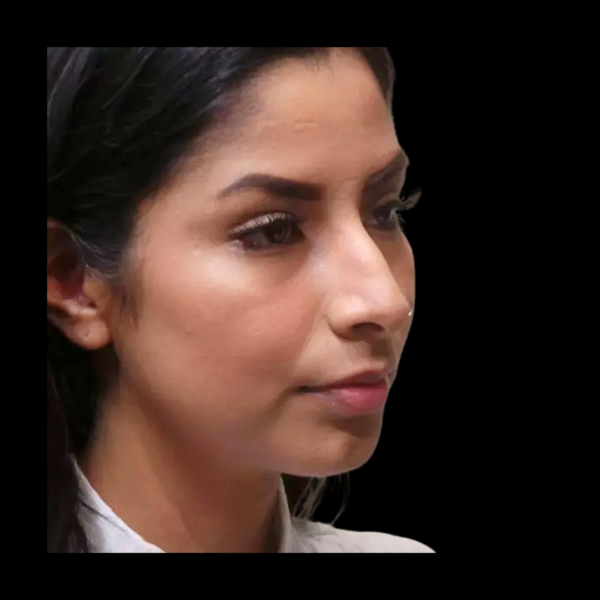Rhinoplasty #360 Before 1