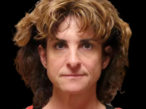 Facelift Patient 09 Before 1