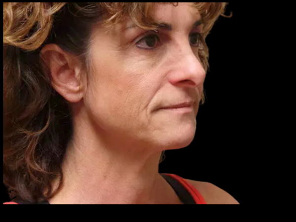 Facelift Patient 09 Before 2