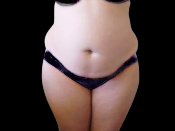 Tummy Tuck Patient 06 Before 1
