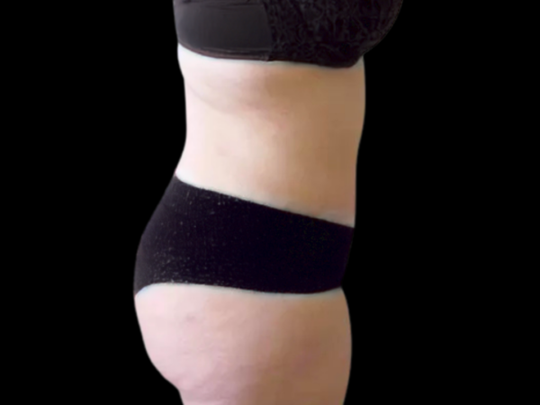 Tummy Tuck Patient 06 After 2