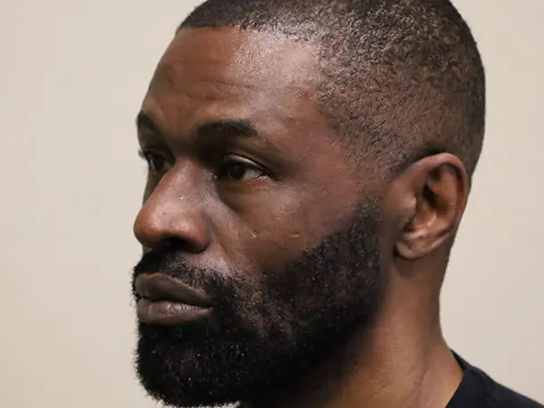 Rhinoplasty Patient 48 Before 2