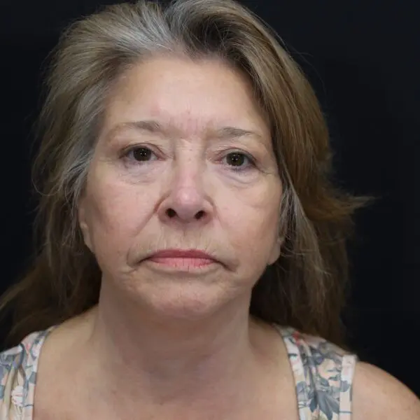 Facelift #1510 After 1