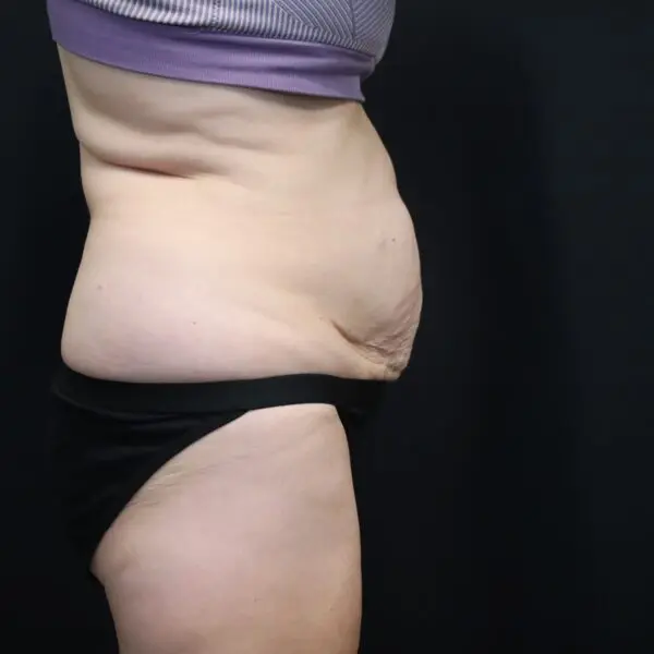 Abdominoplasty #4278 Before 1