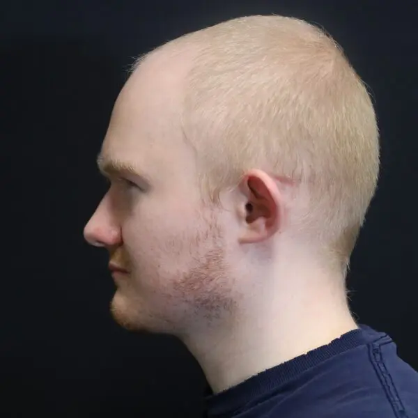 Otoplasty #5410 Before 2