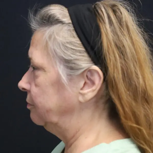 Facelift #1510 Before 2