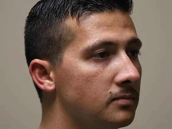 Rhinoplasty Patient 49 After 1