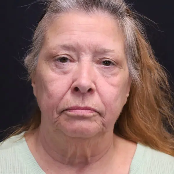 Facelift #1510 Before 1