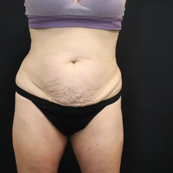 Abdominoplasty #4278 Before 2