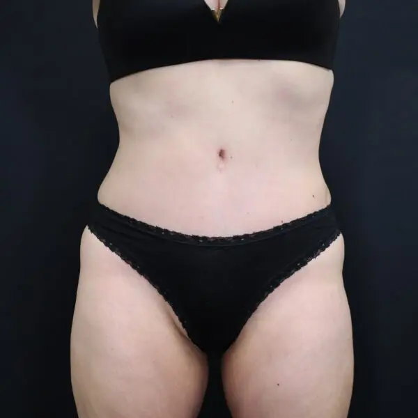 Abdominoplasty #4278 After 2