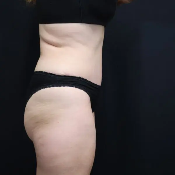 Abdominoplasty #4278 After 1
