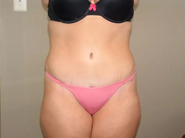 Drainless Tummy Tuck (Abdominoplasty) Patient After
