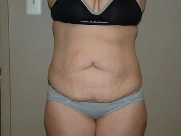 Drainless Tummy Tuck (Abdominoplasty) Patient Before