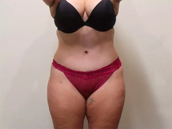 Drainless Tummy Tuck (Abdominoplasty) Patient After