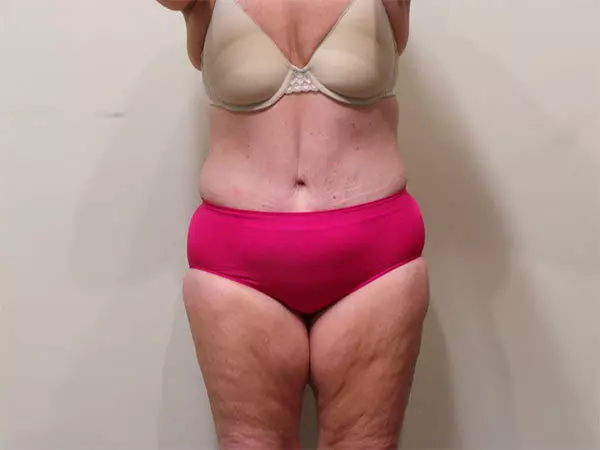 Tummy Tuck Patient 07 After 1