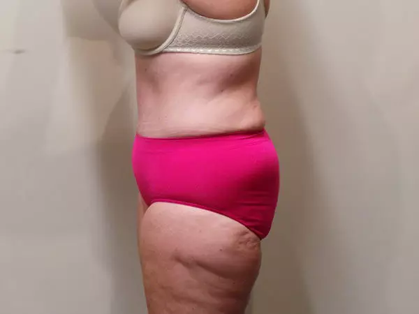 Tummy Tuck Patient 07 After 2